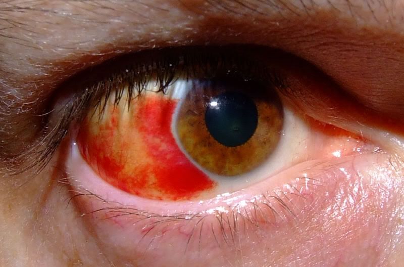 redeye.jpg